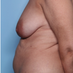 Mommy Makeover Before & After Patient #34313